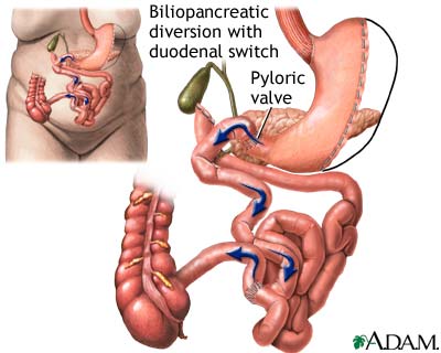 Biliopancreatic diversion with duodenal switch