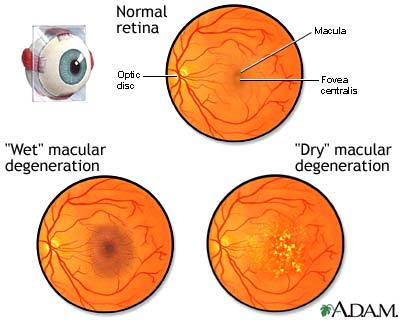 Macular degeneration