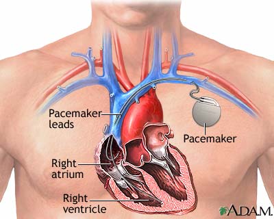 Pacemaker