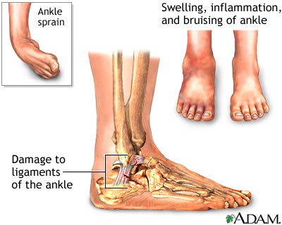 Ankle sprain