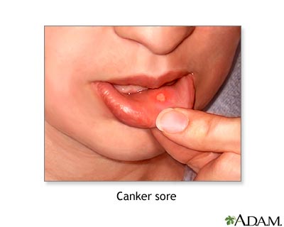 Canker sore