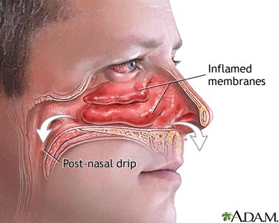 Runny and stuffy nose