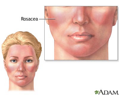 Rosacea