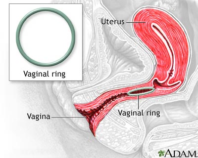 Vaginal ring Vaginal ring