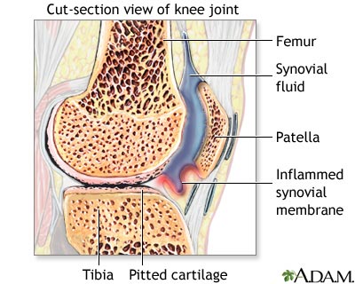 Rheumatoid arthritis