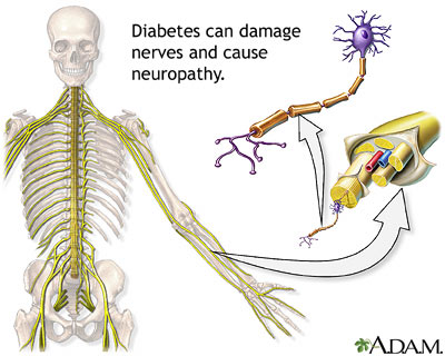 Diabetes and nerve damage Diabetes and nerve damage