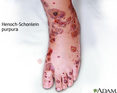 Henoch-Schonlein purpura Henoch-Schonlein purpura