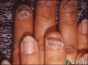 Onycholysis Onycholysis