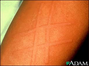 Dermatographism on the arm