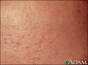 Blackheads (comedones) close-up Blackheads (comedones) close-up