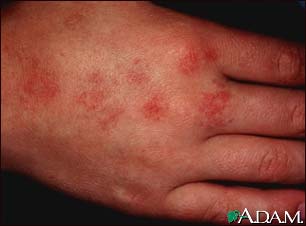 Angioma serpiginosum Angioma serpiginosum