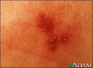 Herpes simplex - close-up Herpes simplex - close-up