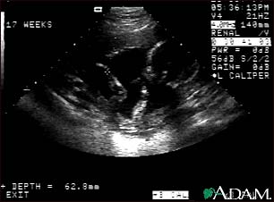 Ultrasound, normal fetus - arm and legs