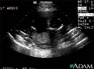 Ultrasound, normal fetus - ventricles of brain Ultrasound, normal fetus - ventricles of brain