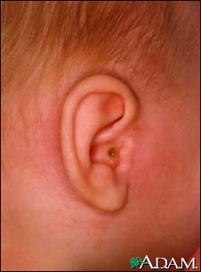 Mastoiditis - side view of head