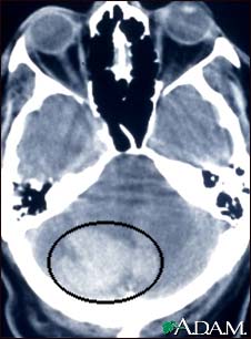 Intracerebellar hemorrhage - CT scan