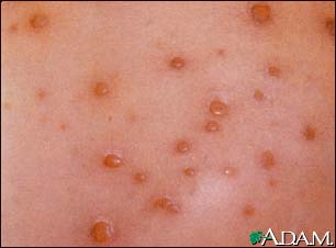 Chickenpox - close-up