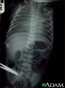 Totally anomalous pulmonary venous return, X-ray