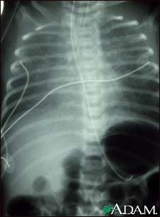 Totally anomalous pulmonary venous return, X-ray Totally anomalous pulmonary venous return, X-ray