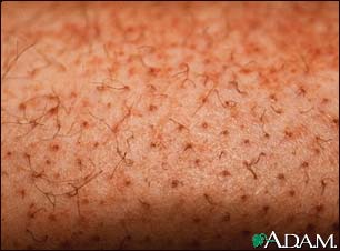 Scurvy, corkscrew hair Scurvy, corkscrew hair