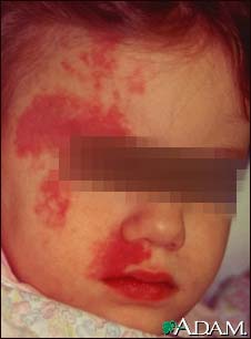 Port wine stain on a child's face Port wine stain on a child's face