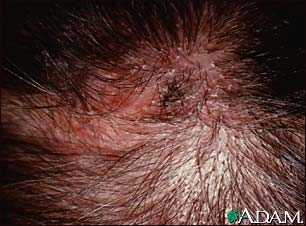 Ringworm, tinea capitis - close-up Ringworm, tinea capitis - close-up