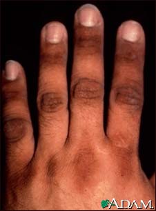 Acanthosis nigricans on the hand Acanthosis nigricans on the hand