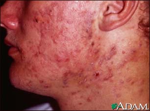 Acne, cystic on the face