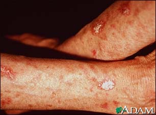 Actinic keratosis on the forearms