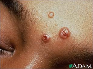 Cryptococcosis on the forehead