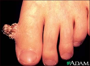Wart (verruca) with a cutaneous horn on the toe Wart (verruca) with a cutaneous horn on the toe