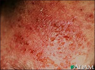 Dermatitis, close-up of allergic contact