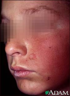 Dermatitis, contact on the cheek