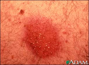 Dermatitis, pustular contact