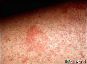 Eczema, atopic - close-up