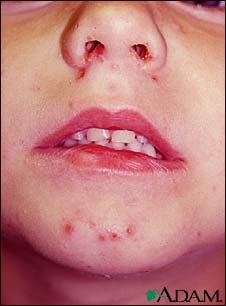 Impetigo on a child's face Impetigo on a child's face