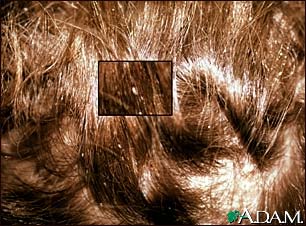 Lice, head - nits in the hair with close-up