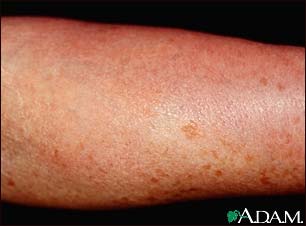 Mastocytosis, diffuse cutaneous Mastocytosis, diffuse cutaneous