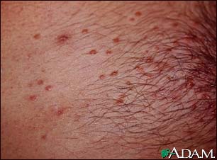 Molluscum on the chest Molluscum on the chest