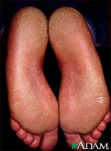 Pitted keratolysis Pitted keratolysis