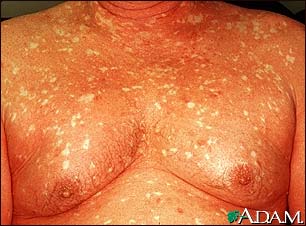 Pityriasis rubra pilaris on the chest Pityriasis rubra pilaris on the chest