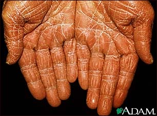 Pityriasis rubra pilaris on the palms Pityriasis rubra pilaris on the palms